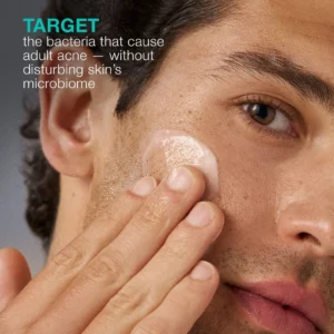 acne biotic moisturizer 1.7oz
