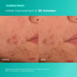 acne biotic moisturizer 1.7oz