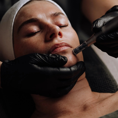 microneedling