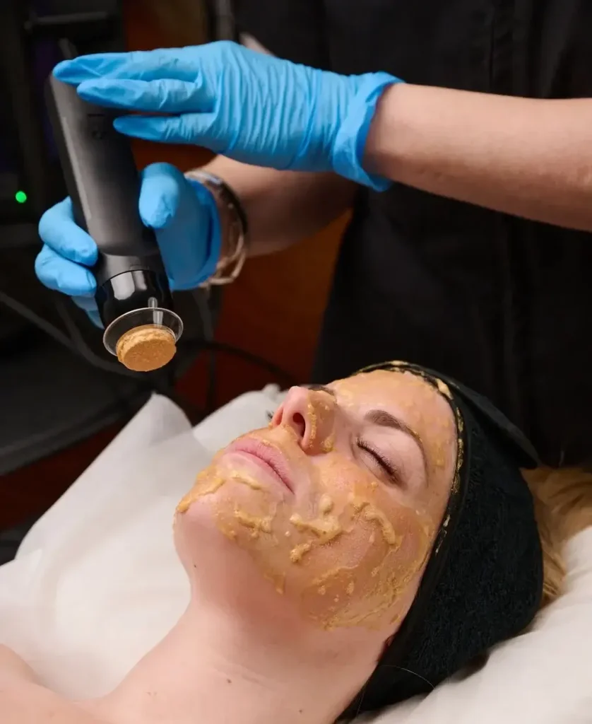 GeneoX 5-in-1 Super Facial: The Next Level of Skin Rejuvenation jan162024 dermaspark 0454 e1737209172155